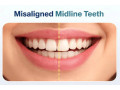 clear-aligners-for-gap-teeth-correction-in-tamil-nadu-small-0