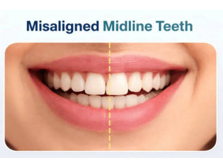 Clear Aligners For Gap Teeth Correction In Tamil Nadu